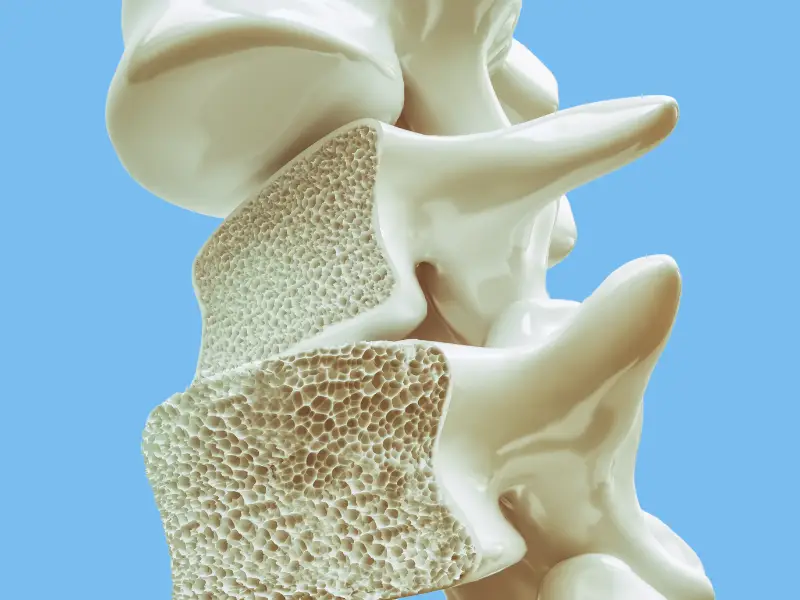 Wirbelkörper sind als Knochen abgebildet, um eine Osteoporose zu verbildlichen.